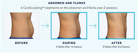 coolsculpting how long for results.